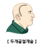 개두술