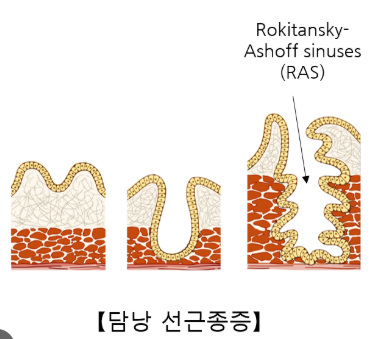 담낭선근종증